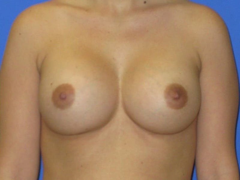 Breast Augmentation Before & After Gallery - Patient 422642 - Image 2