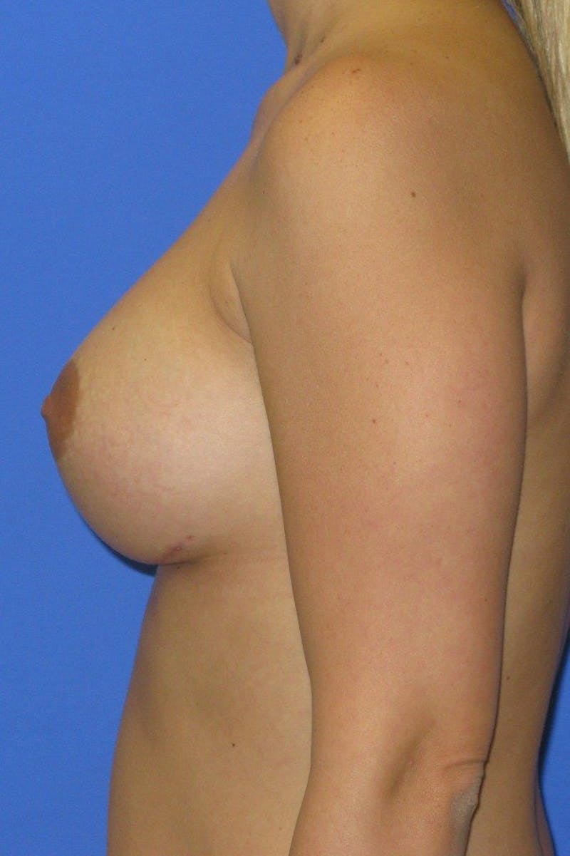 Breast Augmentation Before & After Gallery - Patient 422642 - Image 6