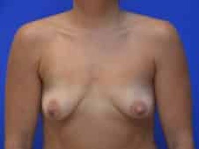 Breast Augmentation Before & After Gallery - Patient 341315 - Image 1