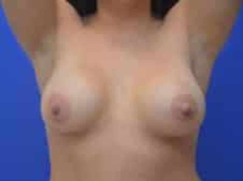 Breast Augmentation Before & After Gallery - Patient 341315 - Image 4