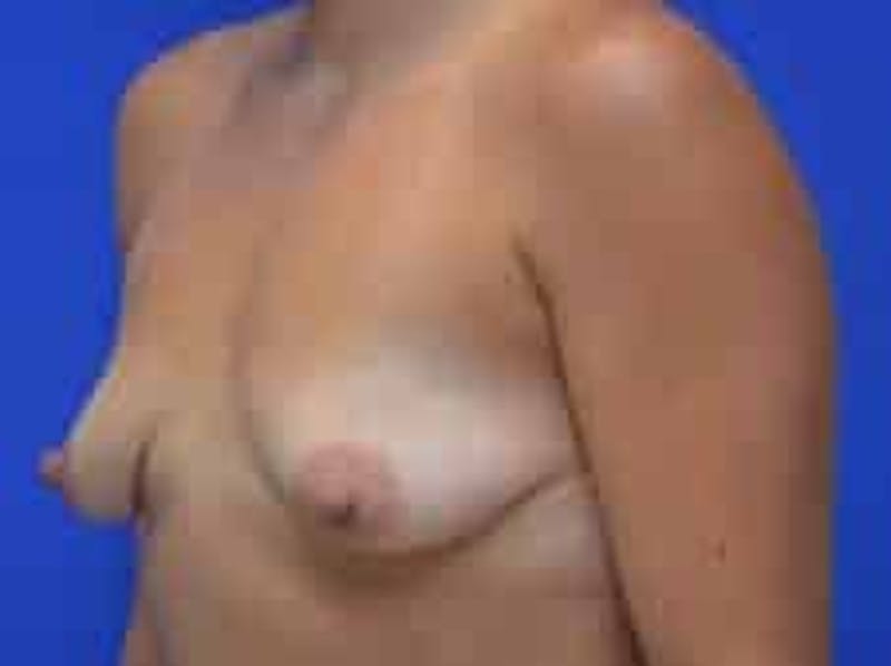 Breast Augmentation Before & After Gallery - Patient 341315 - Image 5