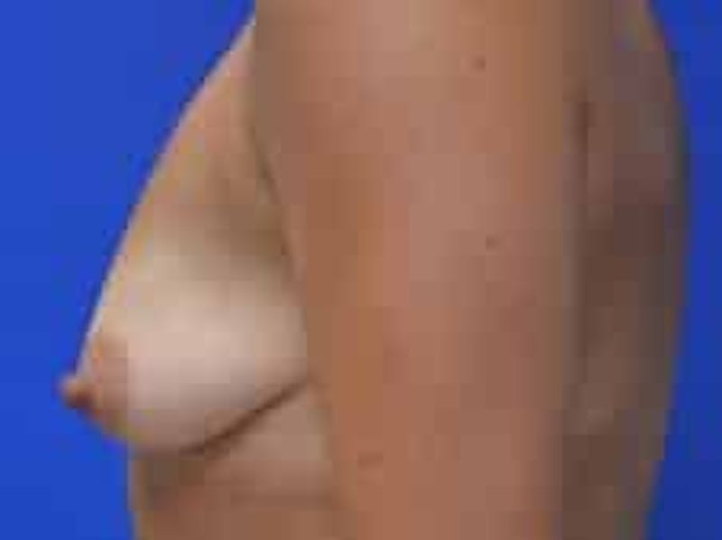 Breast Augmentation Before & After Gallery - Patient 341315 - Image 7
