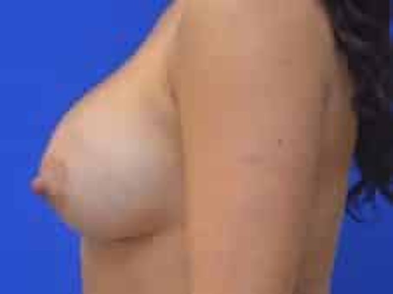 Breast Augmentation Before & After Gallery - Patient 341315 - Image 8