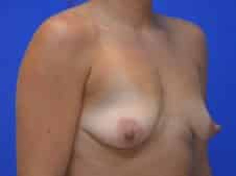 Breast Augmentation Before & After Gallery - Patient 341315 - Image 9