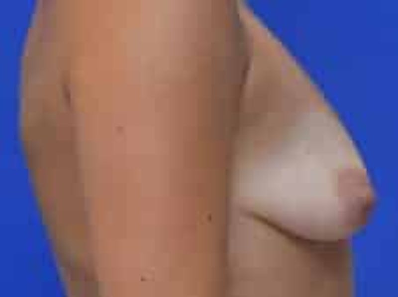 Breast Augmentation Before & After Gallery - Patient 341315 - Image 11