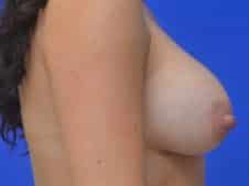 Breast Augmentation Before & After Gallery - Patient 341315 - Image 12