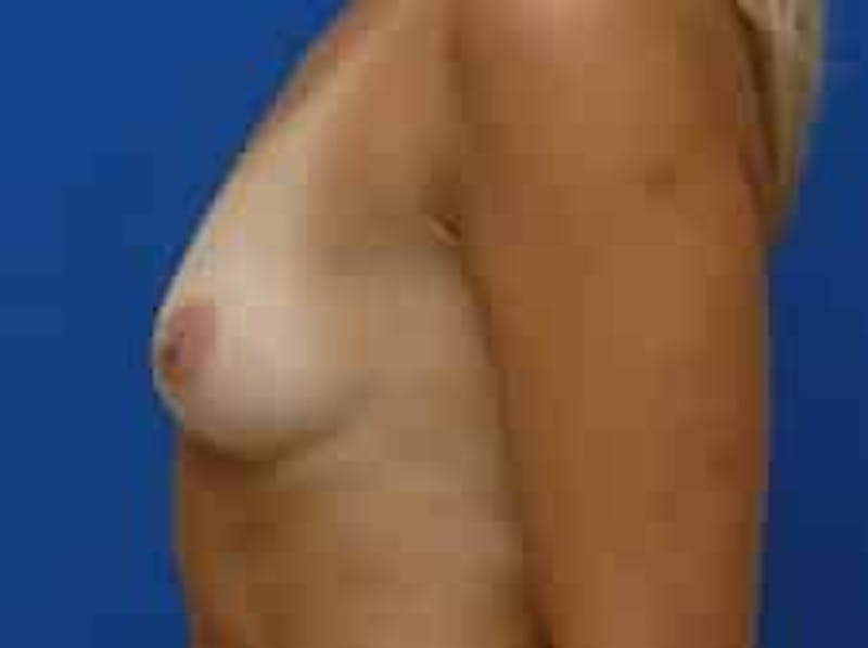 Breast Augmentation Before & After Gallery - Patient 541377 - Image 5
