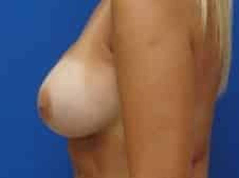 Breast Augmentation Before & After Gallery - Patient 541377 - Image 6