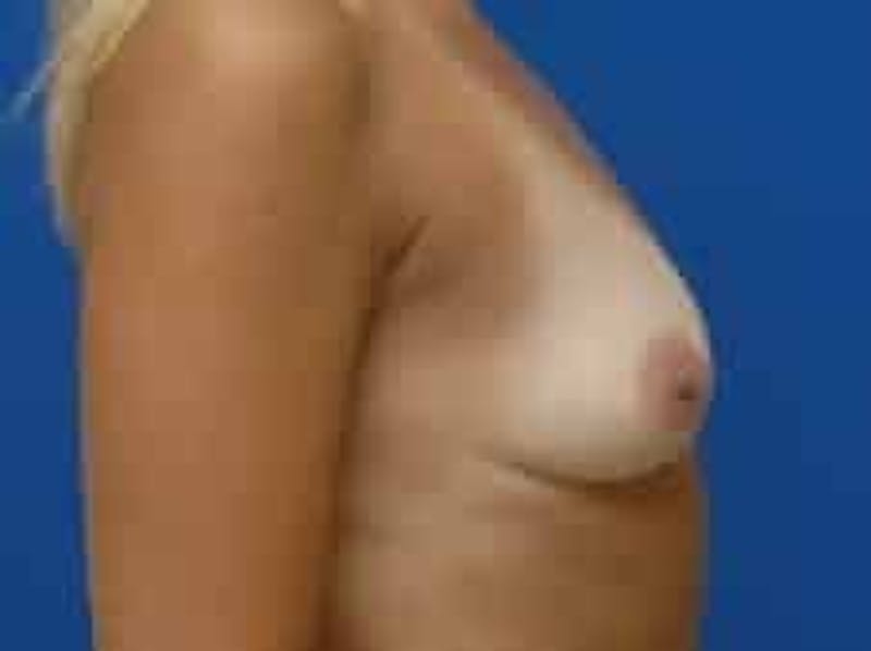 Breast Augmentation Before & After Gallery - Patient 541377 - Image 9