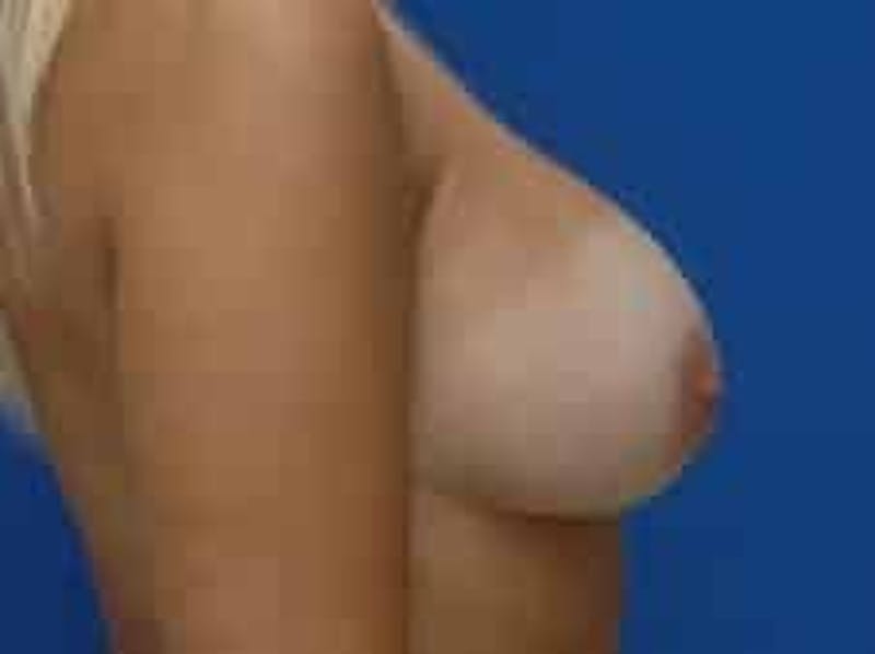 Breast Augmentation Before & After Gallery - Patient 541377 - Image 10