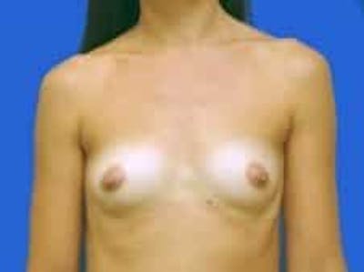 Breast Augmentation Before & After Gallery - Patient 164268 - Image 1