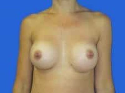 Breast Augmentation Before & After Gallery - Patient 164268 - Image 2