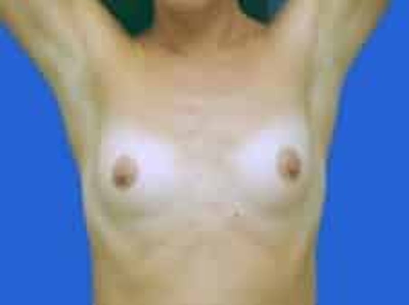 Breast Augmentation Before & After Gallery - Patient 164268 - Image 3