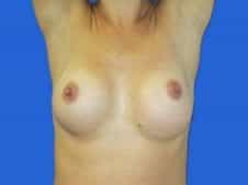 Breast Augmentation Before & After Gallery - Patient 164268 - Image 4