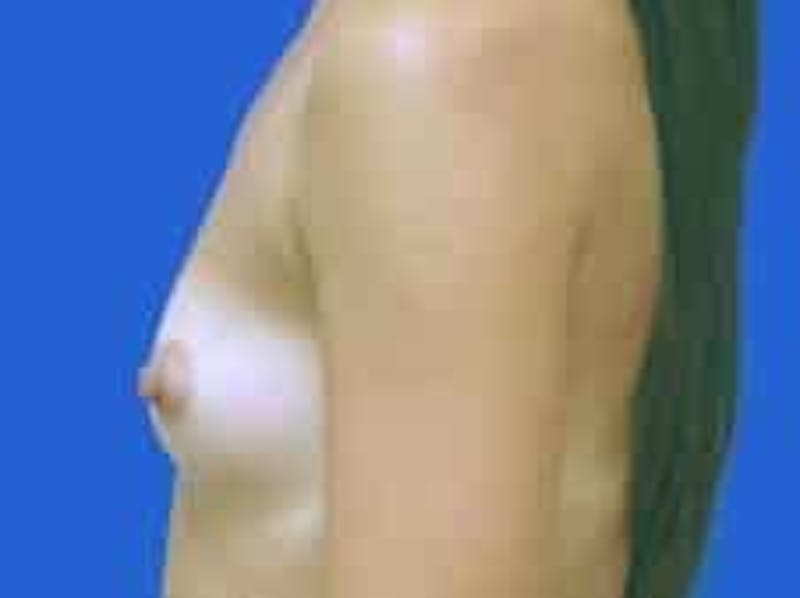 Breast Augmentation Before & After Gallery - Patient 164268 - Image 5