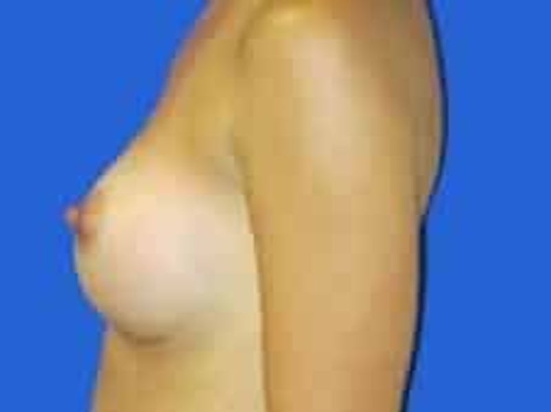Breast Augmentation Before & After Gallery - Patient 164268 - Image 6