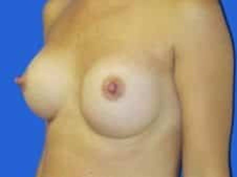 Breast Augmentation Before & After Gallery - Patient 164268 - Image 8