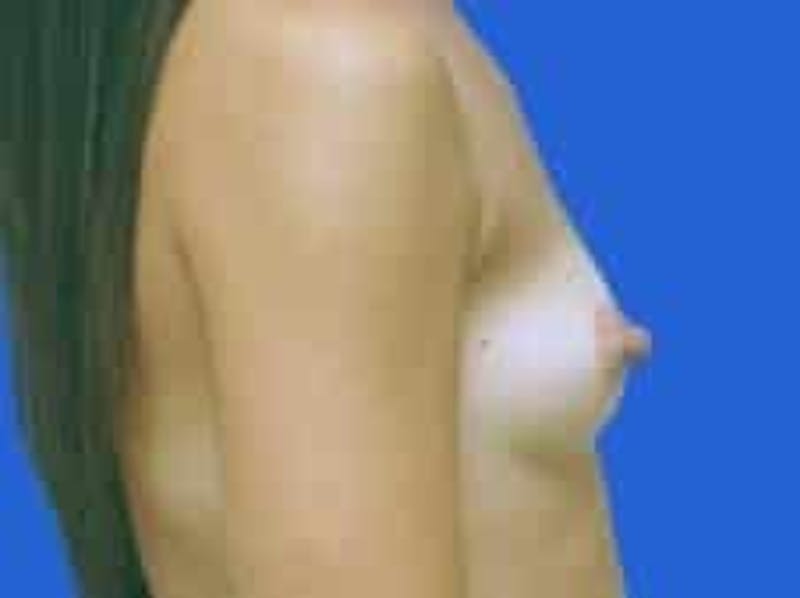 Breast Augmentation Before & After Gallery - Patient 164268 - Image 9
