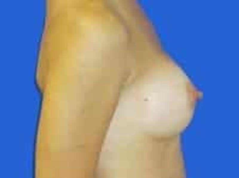 Breast Augmentation Before & After Gallery - Patient 164268 - Image 10
