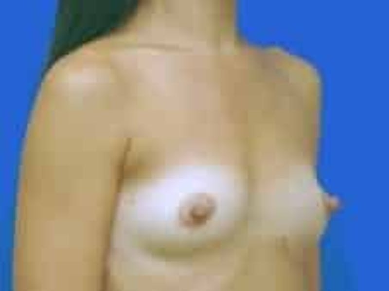 Breast Augmentation Before & After Gallery - Patient 164268 - Image 11