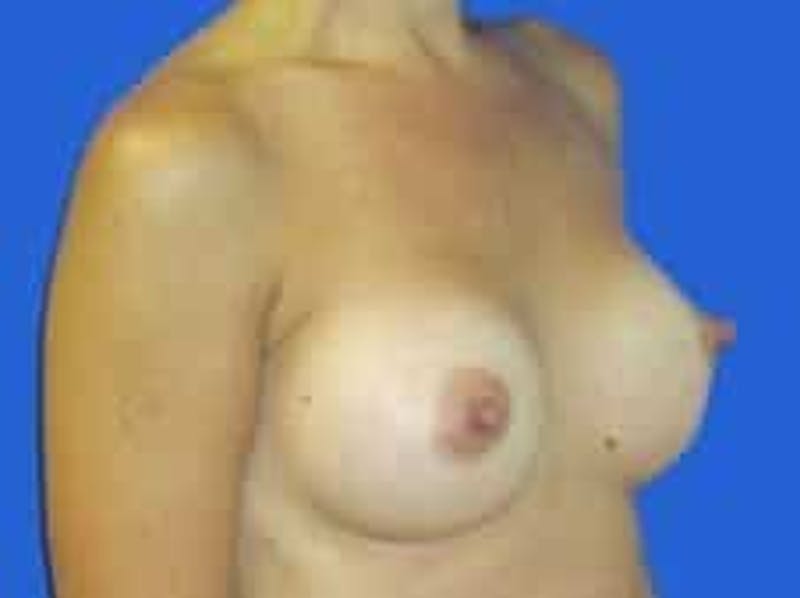 Breast Augmentation Before & After Gallery - Patient 164268 - Image 12