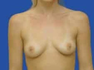 Breast Augmentation Before & After Gallery - Patient 242199 - Image 1