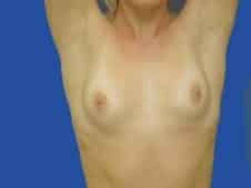 Breast Augmentation Before & After Gallery - Patient 242199 - Image 3