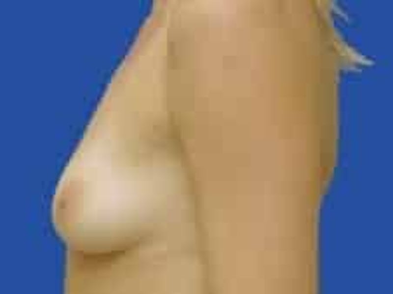 Breast Augmentation Before & After Gallery - Patient 242199 - Image 5