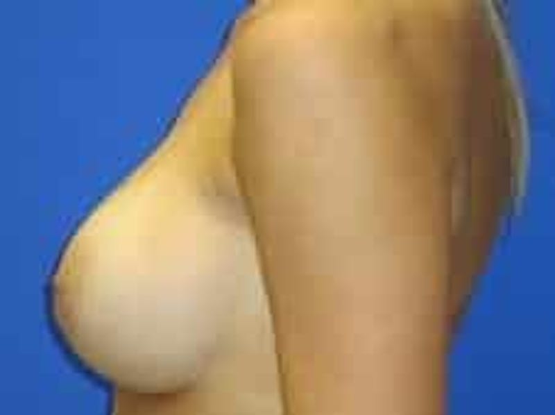 Breast Augmentation Before & After Gallery - Patient 242199 - Image 6