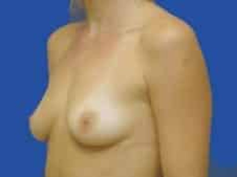Breast Augmentation Before & After Gallery - Patient 242199 - Image 7