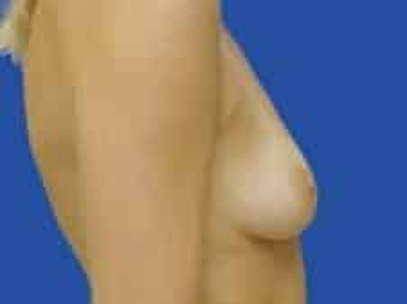 Breast Augmentation Before & After Gallery - Patient 242199 - Image 9