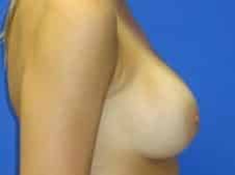 Breast Augmentation Before & After Gallery - Patient 242199 - Image 10