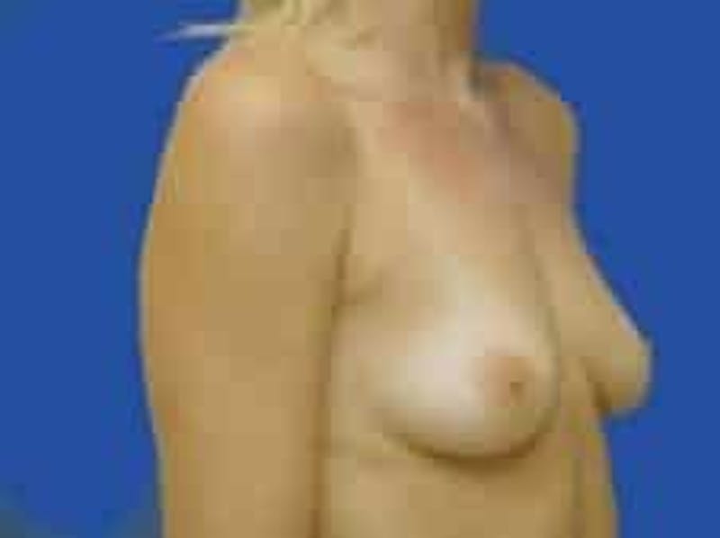 Breast Augmentation Before & After Gallery - Patient 242199 - Image 11