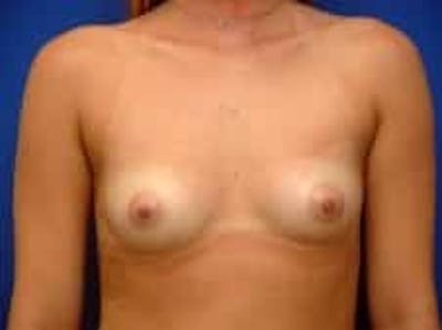 Breast Augmentation Before & After Gallery - Patient 393988 - Image 1