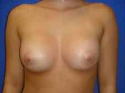 Breast Augmentation Before & After Gallery - Patient 393988 - Image 2