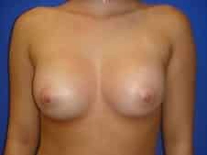 Breast Augmentation Before & After Gallery - Patient 393988 - Image 2