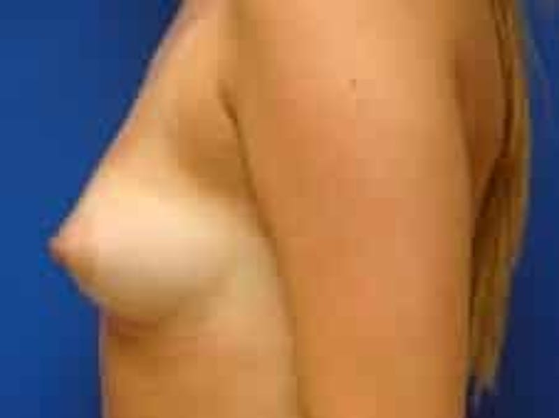Breast Augmentation Before & After Gallery - Patient 393988 - Image 5