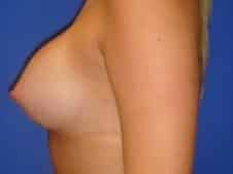 Breast Augmentation Before & After Gallery - Patient 393988 - Image 6