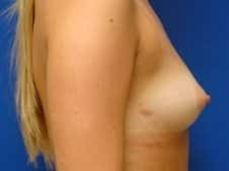 Breast Augmentation Before & After Gallery - Patient 393988 - Image 9