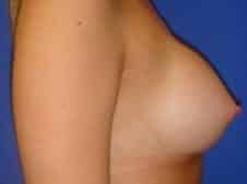 Breast Augmentation Before & After Gallery - Patient 393988 - Image 10