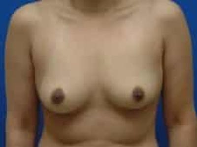 Breast Augmentation Before & After Gallery - Patient 199319 - Image 1