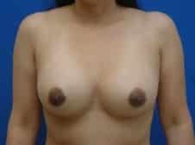 Breast Augmentation Before & After Gallery - Patient 199319 - Image 2