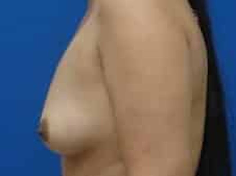 Breast Augmentation Before & After Gallery - Patient 199319 - Image 3