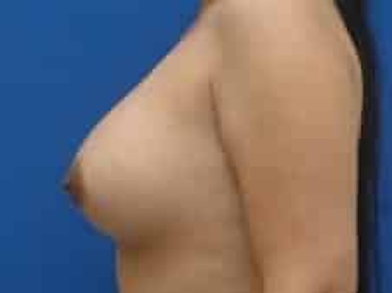 Breast Augmentation Before & After Gallery - Patient 199319 - Image 4