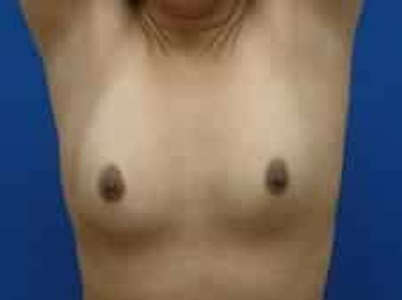 Breast Augmentation Before & After Gallery - Patient 199319 - Image 5