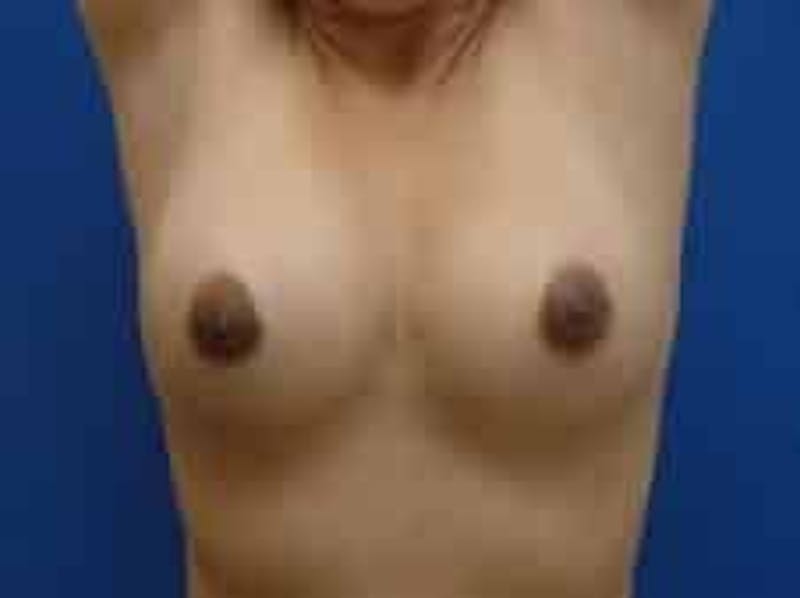Breast Augmentation Before & After Gallery - Patient 199319 - Image 6
