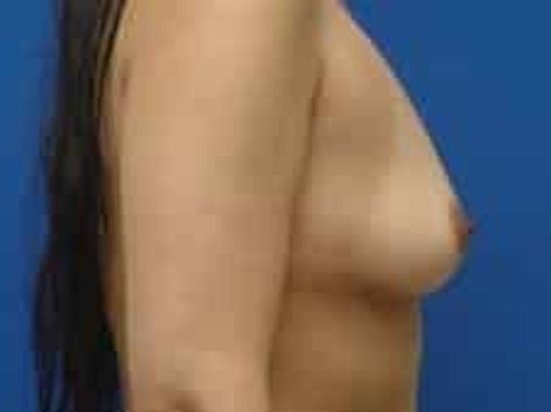 Breast Augmentation Before & After Gallery - Patient 199319 - Image 11