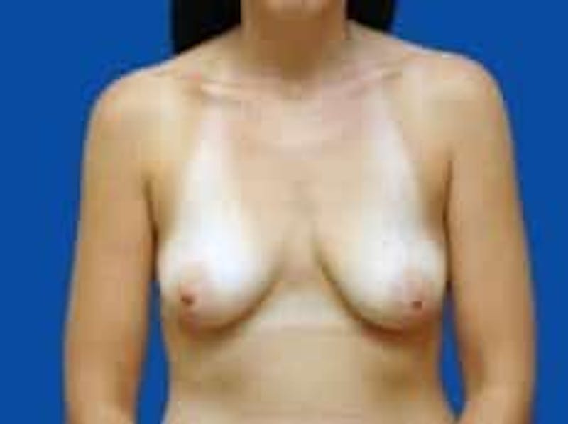 Breast Augmentation Before & After Gallery - Patient 285129 - Image 1