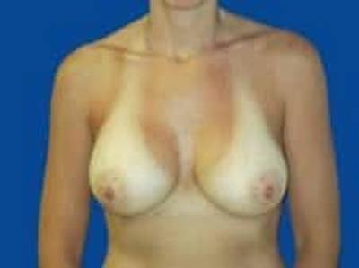 Breast Augmentation Before & After Gallery - Patient 285129 - Image 2