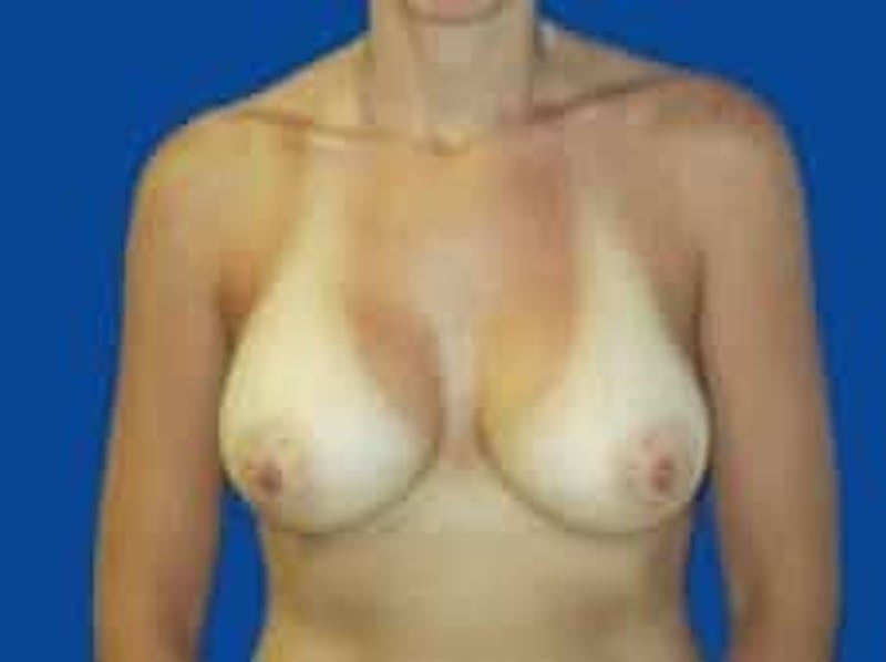 Breast Augmentation Before & After Gallery - Patient 285129 - Image 2